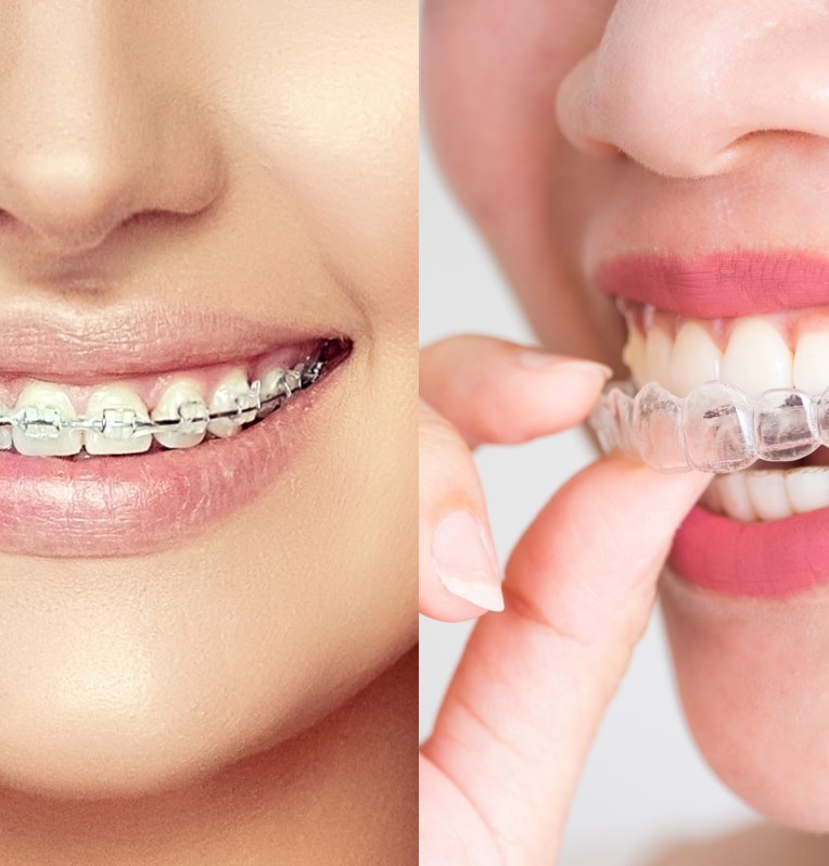 Orthodontics In Dubai, Klinika Dental Clinic