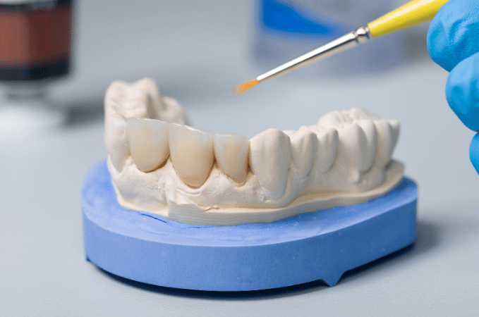 Dental Crowns Treatment in Dubai: The Complete Guide