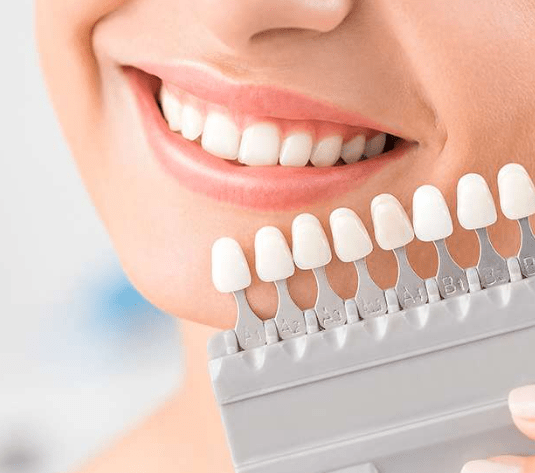 How to Prepare for Dental Veneers