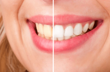Teeth Whitening : How to Achieve the Best Results