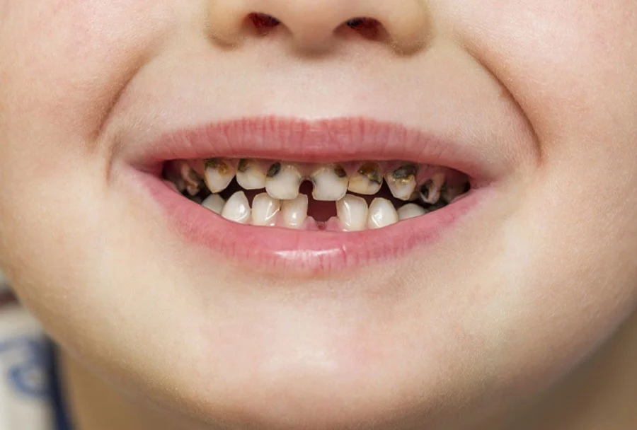 Babies and Their Tooth Decay How Can Parents Prevent It