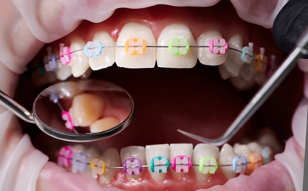 Orthodontics: A Complete Guide