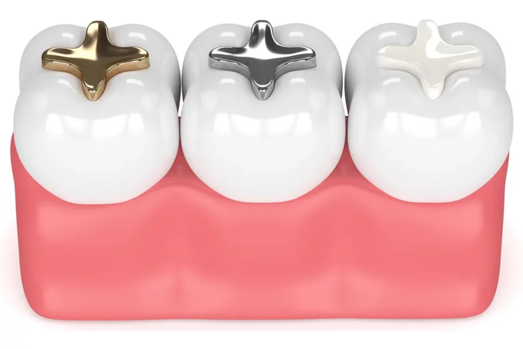 Tooth Fillings or Dental Fillings at Klinika Dental Clinic in Dubai