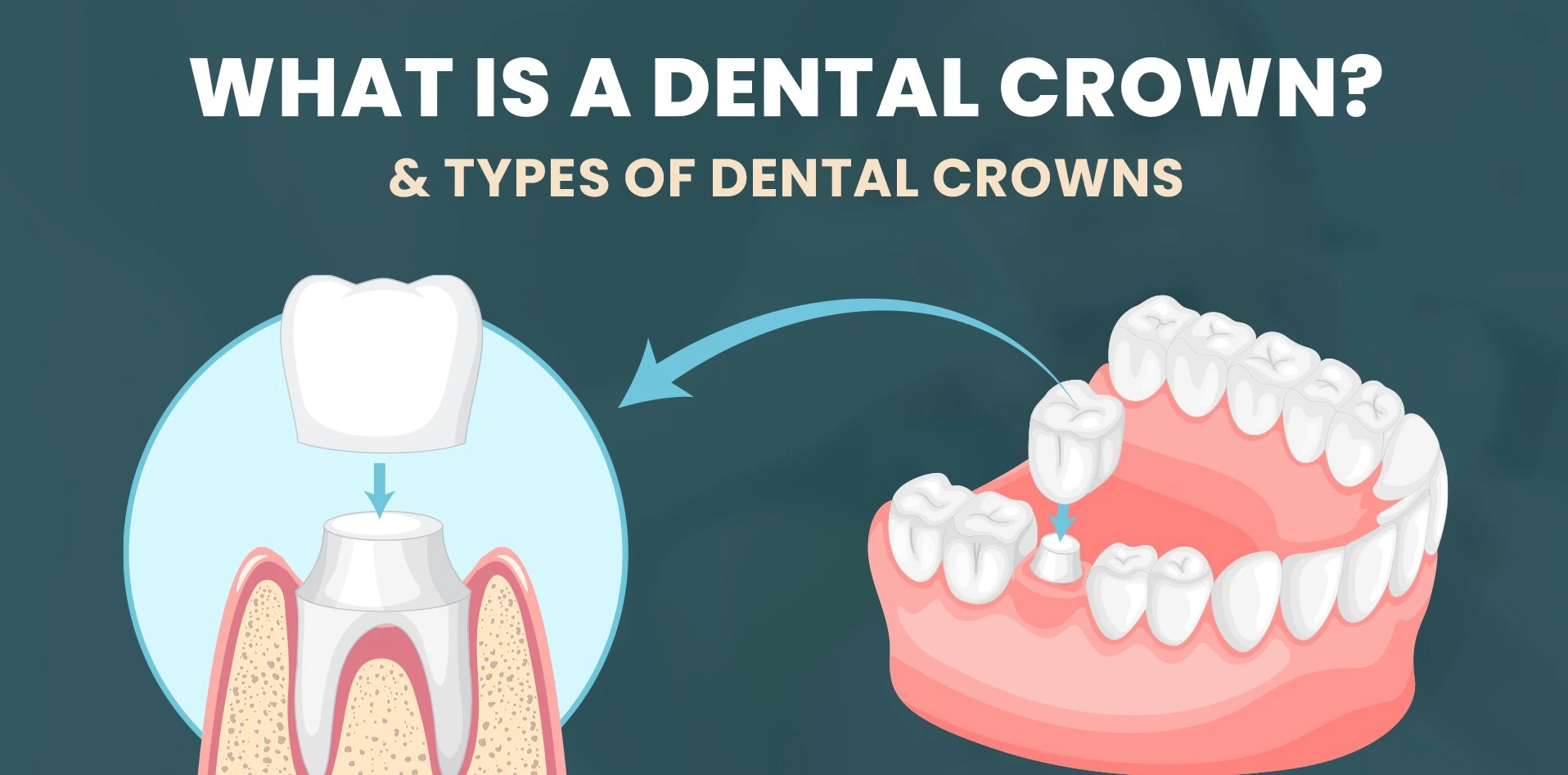 What are the Different Types of Dental Crowns?