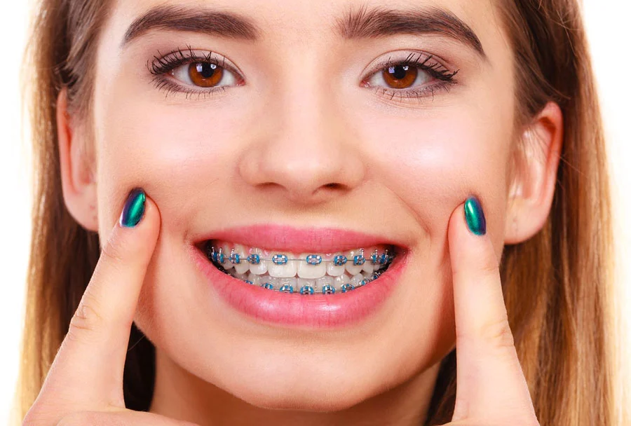Why Do Most People Prefer Braces Than Clear Aligners