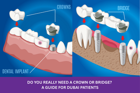 Crown or bridge