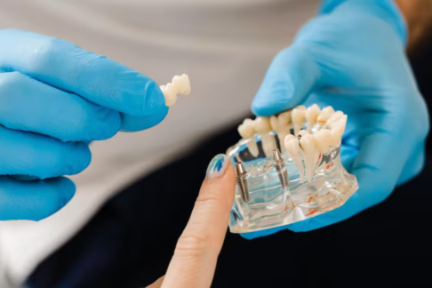 Dental Implants in UAE