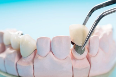 Prosthodontics Treatment in Dubai
