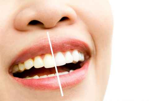 Teeth Whitening Treatments in Dubai