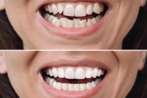 Smile Makeover