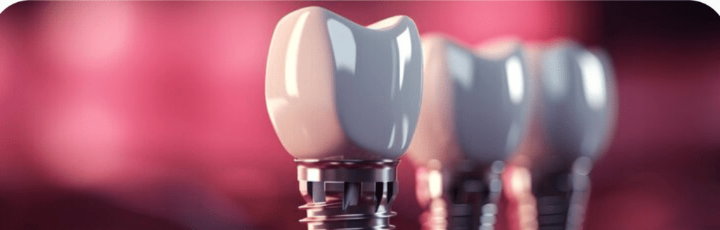 Dental Implants in UAE