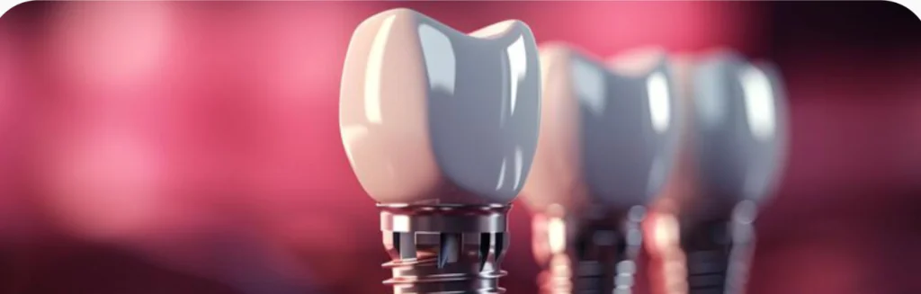 Dental Implants in UAE