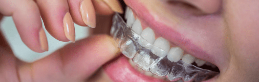 Orthodontic treatment in Dubai