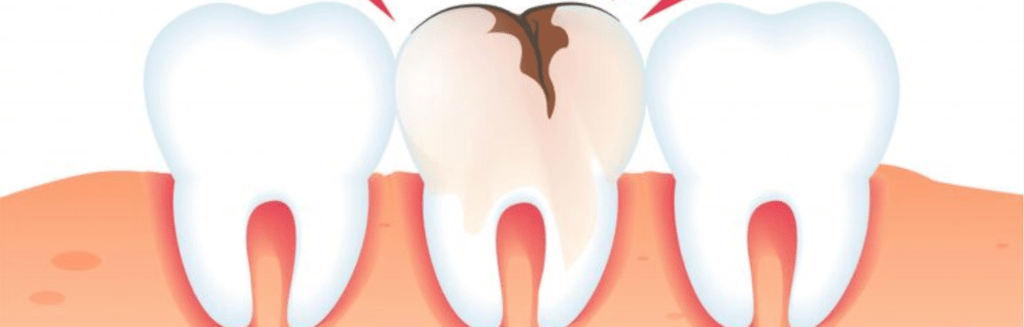 dead tooth treatment