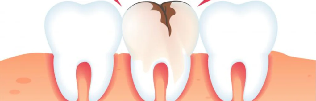 dead tooth treatment