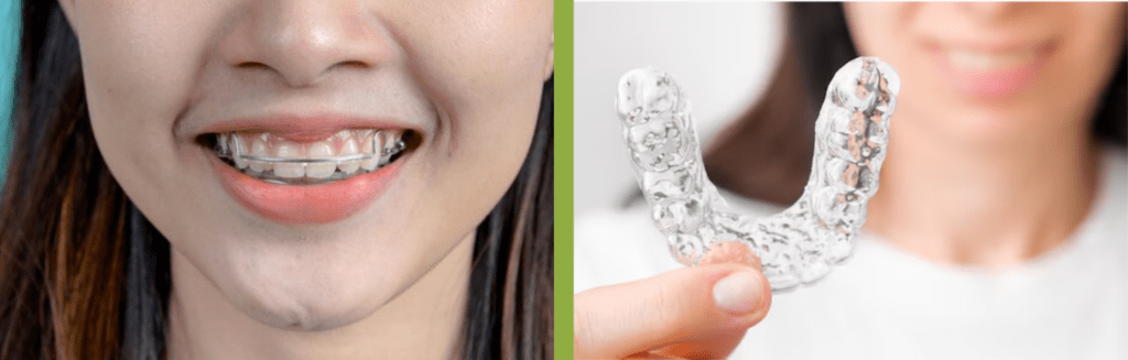 orthodontic treatment in Dubai