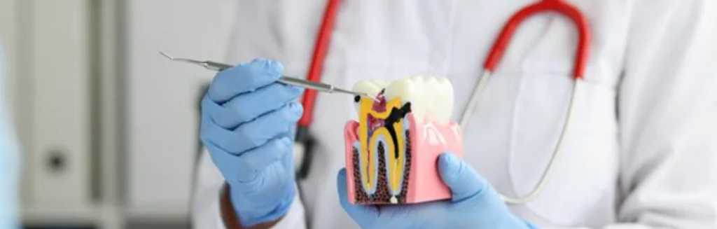Root canals save your teeth