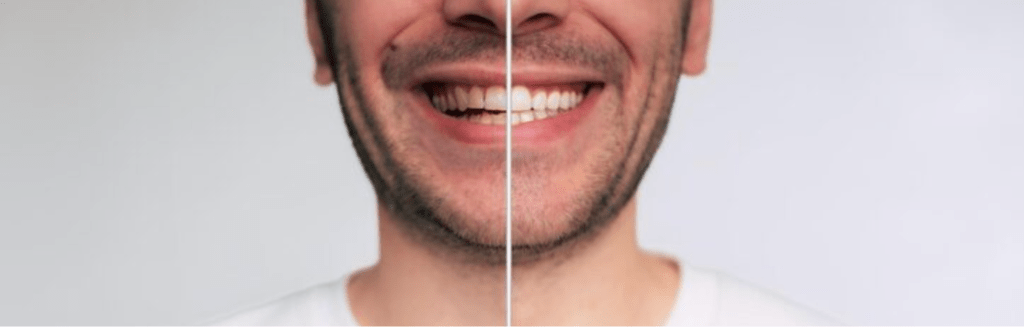 teeth whitening treatment
