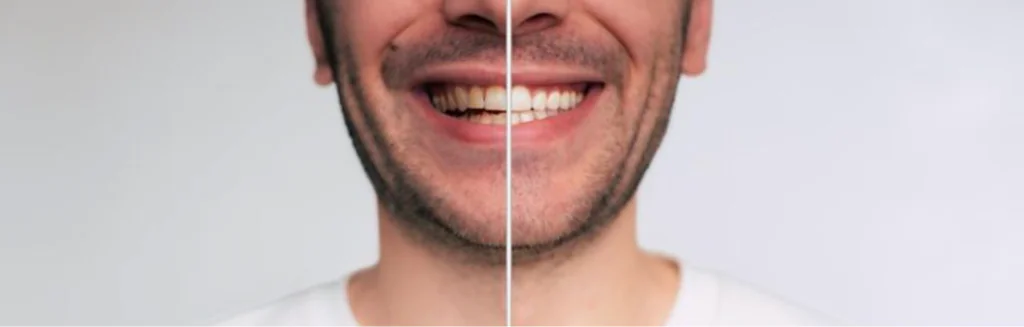 teeth whitening treatment