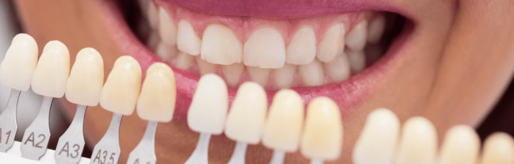 best veneer material