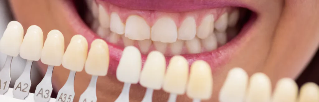 best veneer material